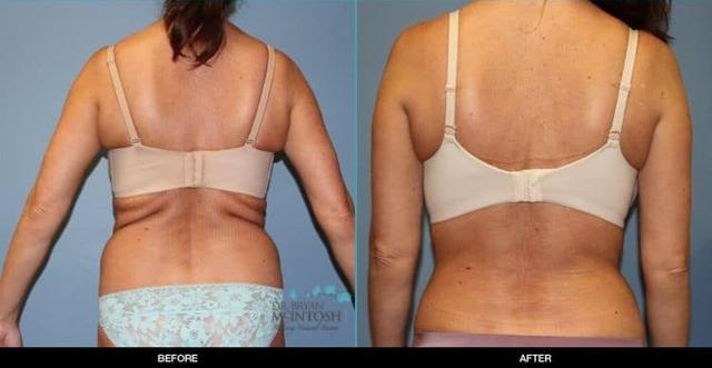 Liposuction result at Refine MD, Northwest in Bellevue, WA