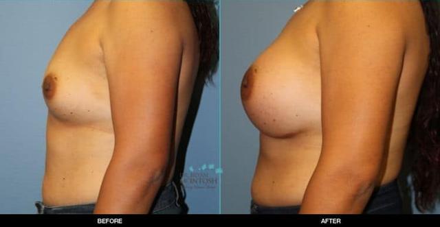 Breast Augmentation result at Refine MD, Northwest in Bellevue, WA