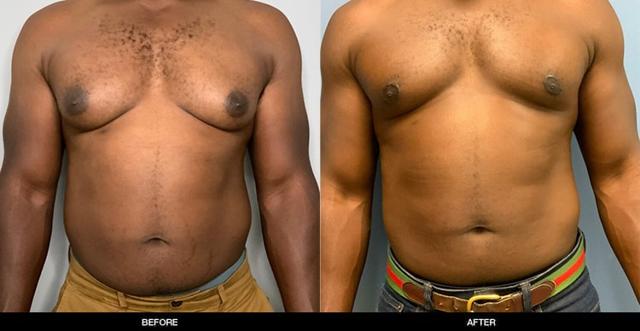 Gynecomastia Surgery result at Refine MD, Northwest in Bellevue, WA