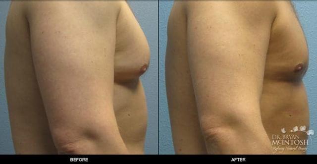 Gynecomastia Surgery result at Refine MD, Northwest in Bellevue, WA