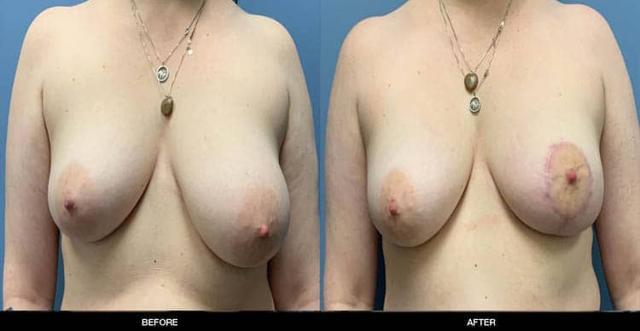 Breast Reduction result at Refine MD, Northwest in Bellevue, WA