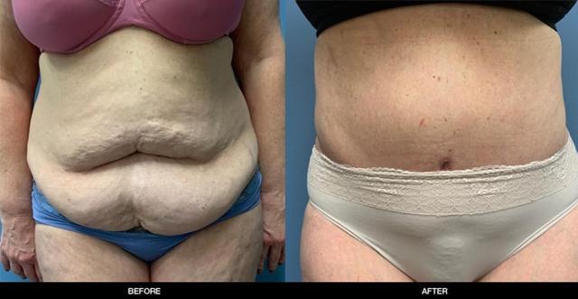 Mini Tummy Tuck result at Refine MD, Northwest in Bellevue, WA