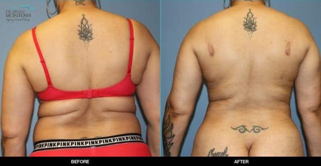 Liposuction result at Refine MD, Northwest in Bellevue, WA