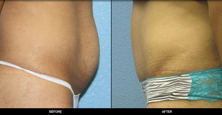 Refine MD, Northwest tummy tuck result — Bellevue, WA