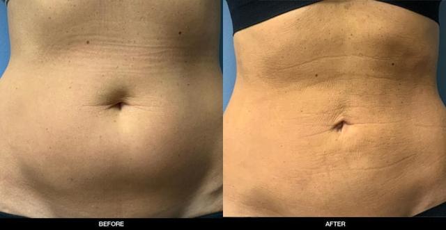 Liposuction result at Refine MD, Northwest in Bellevue, WA