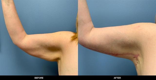 Arm Lift result at Refine MD, Northwest in Bellevue, WA