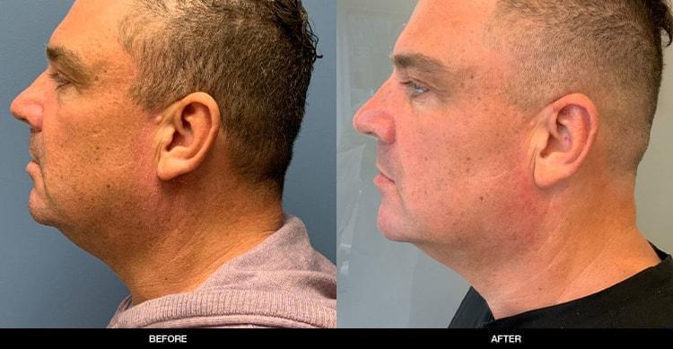Refine MD, Northwest neck lift result — Bellevue, WA