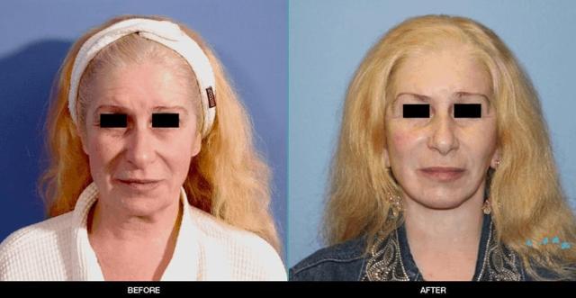 Brow Lift result at Refine MD, Northwest in Bellevue, WA