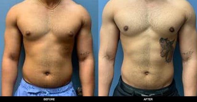 Gynecomastia Surgery result at Refine MD, Northwest in Bellevue, WA