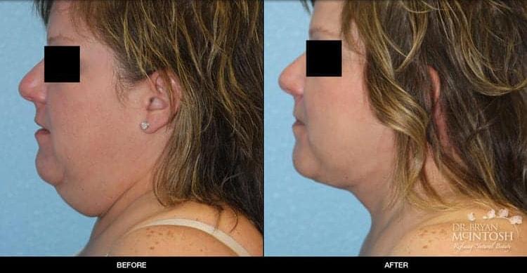 Refine MD, Northwest neck lift result — Bellevue, WA