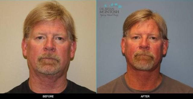 Neck Lift result at Refine MD, Northwest in Bellevue, WA