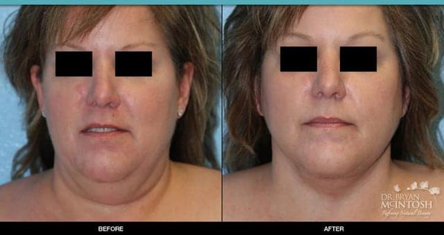 Facelift result at Refine MD, Northwest in Bellevue, WA