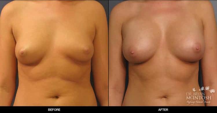 Refine MD, Northwest breast augmentation result — Bellevue, WA