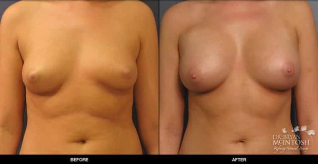 Breast Augmentation result at Refine MD, Northwest in Bellevue, WA