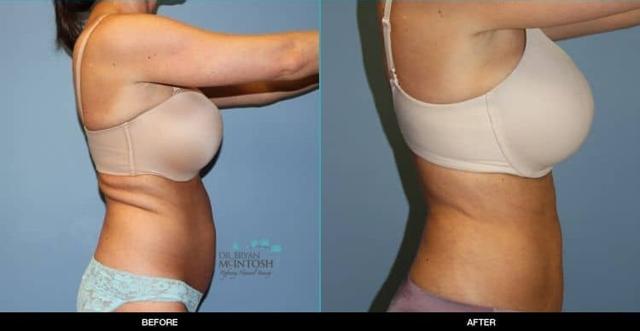 Liposuction result at Refine MD, Northwest in Bellevue, WA