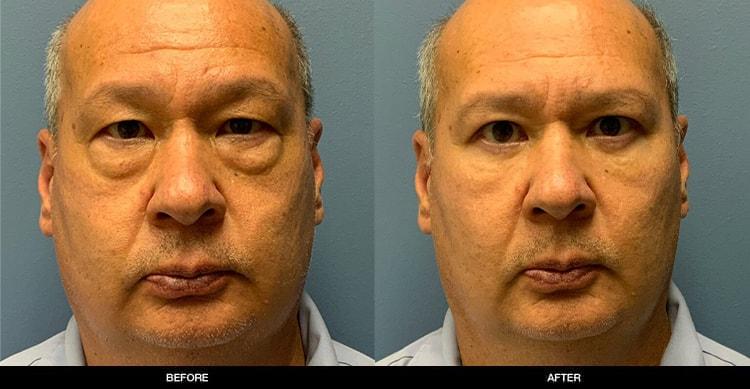 Refine MD, Northwest eyelid lift result — Bellevue, WA