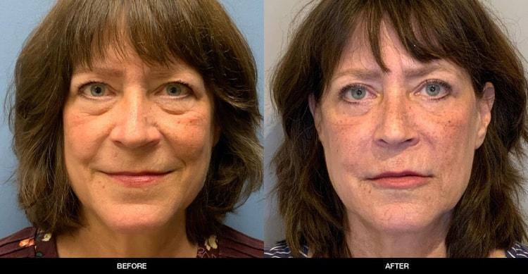 Refine MD, Northwest eyelid lift result — Bellevue, WA