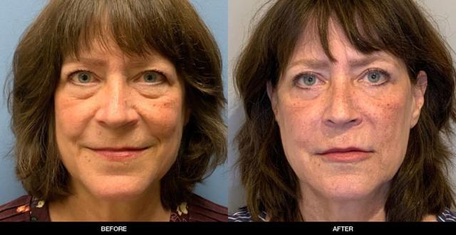 Blepharoplasty result at Refine MD, Northwest in Bellevue, WA