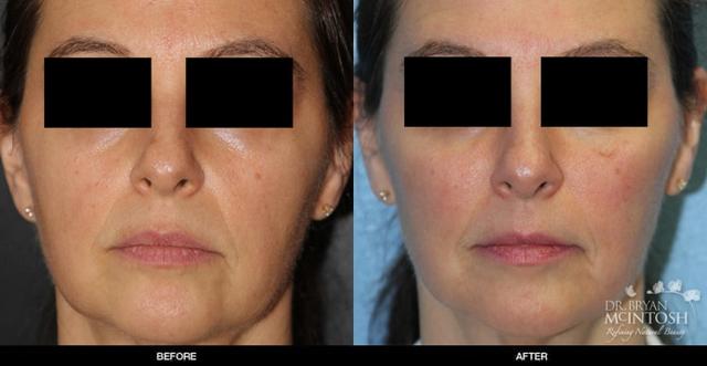 Juvederm result at Refine MD, Northwest in Bellevue, WA