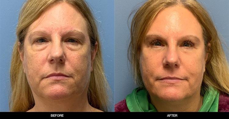 Refine MD, Northwest eyelid lift result — Bellevue, WA