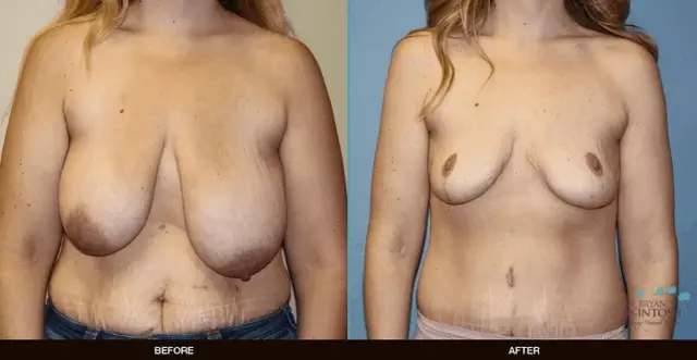 Mommy Makeover result at Refine MD, Northwest in Bellevue, WA