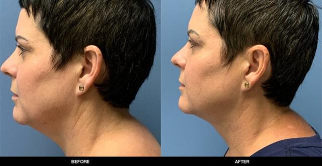Neck Liposuction result at Refine MD, Northwest in Bellevue, WA