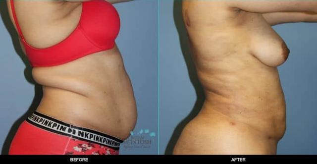 Liposuction result at Refine MD, Northwest in Bellevue, WA