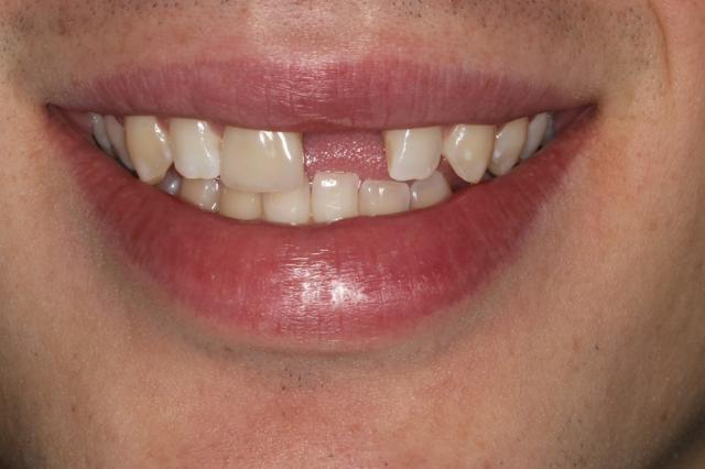 Dental Crowns before at The Dentistry Collective in San Diego, CA