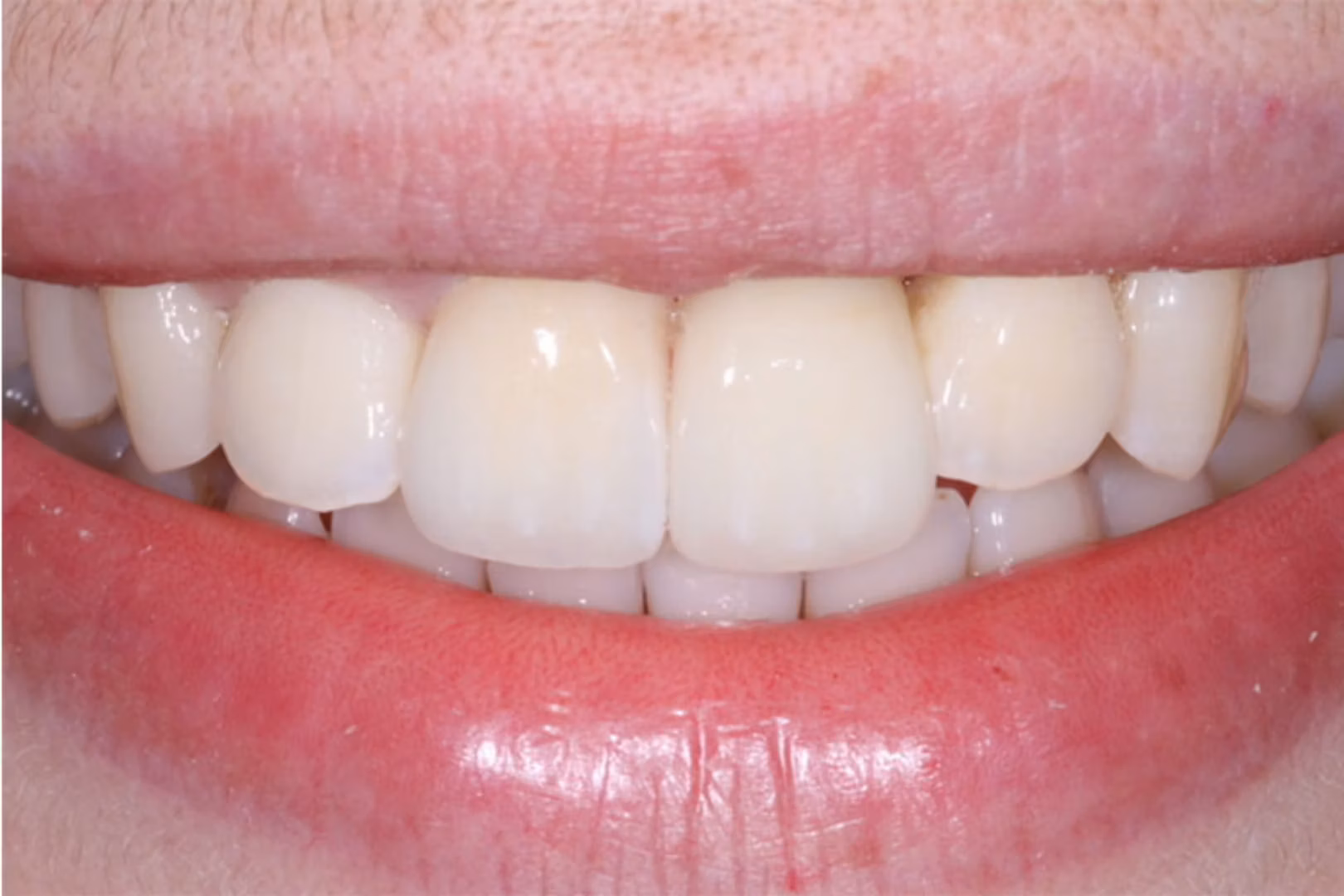 The Dentistry Collective dental implants after — San Diego, CA