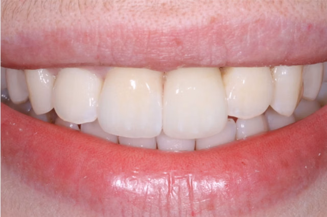 Dental Implants after at The Dentistry Collective in San Diego, CA
