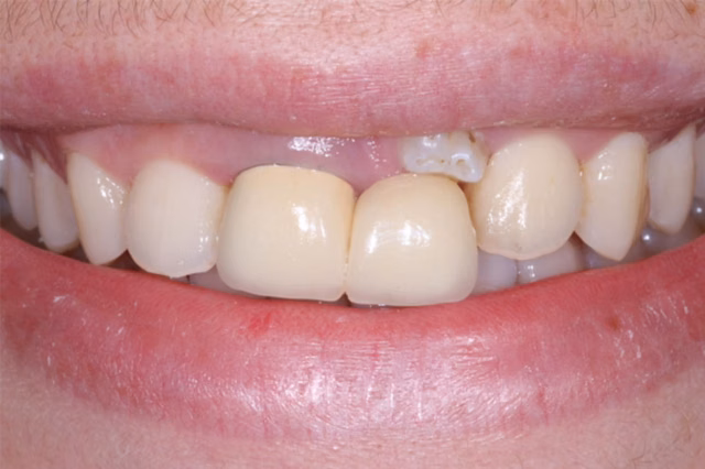 Dental Implants before at The Dentistry Collective in San Diego, CA
