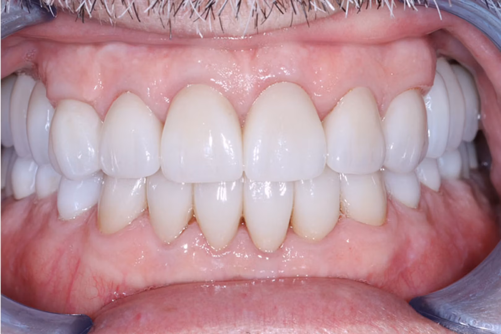 The Dentistry Collective smile makeover after — San Diego, CA