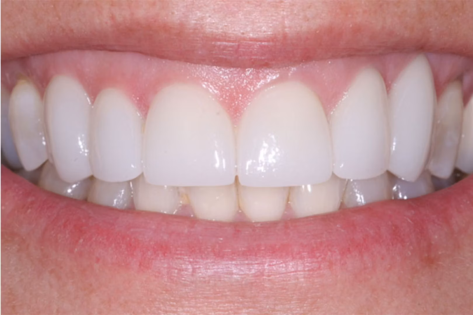 The Dentistry Collective dental crowns after — San Diego, CA