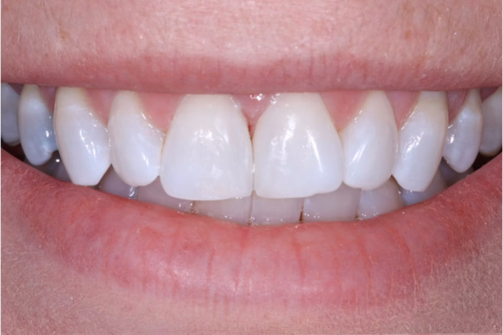 The Dentistry Collective dental bonding after — San Diego, CA