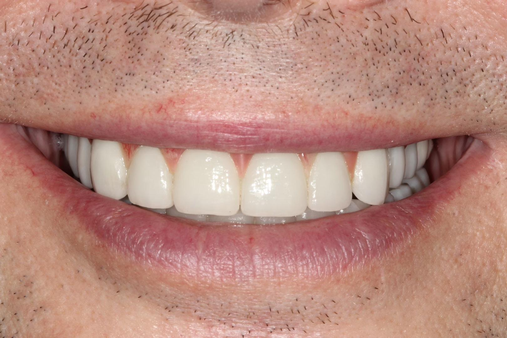 The Dentistry Collective smile makeover after — San Diego, CA