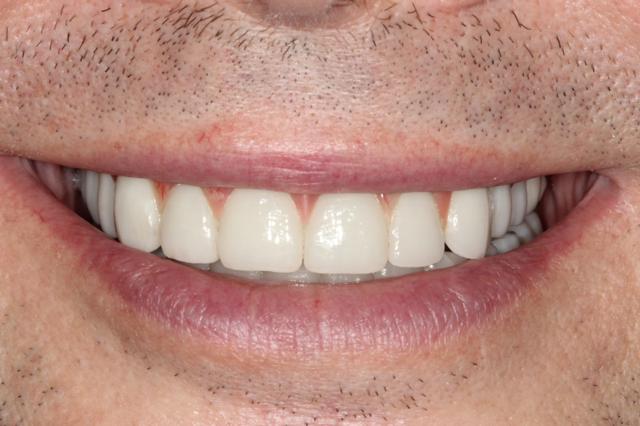 Smile Makeover after at The Dentistry Collective in San Diego, CA