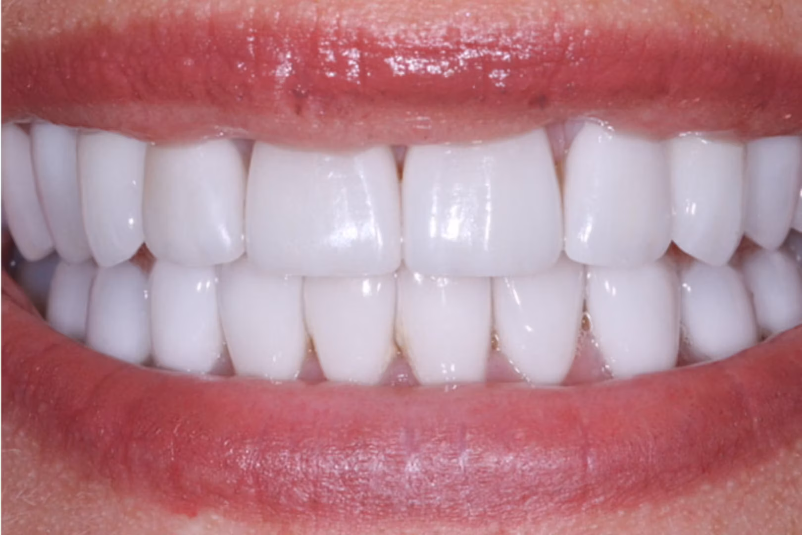 The Dentistry Collective veneers after — San Diego, CA