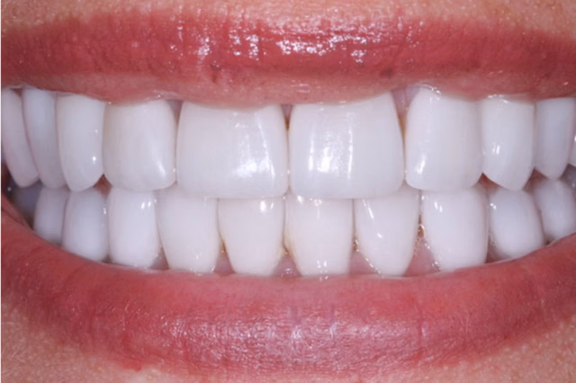 Dental Veneers after at The Dentistry Collective in San Diego, CA