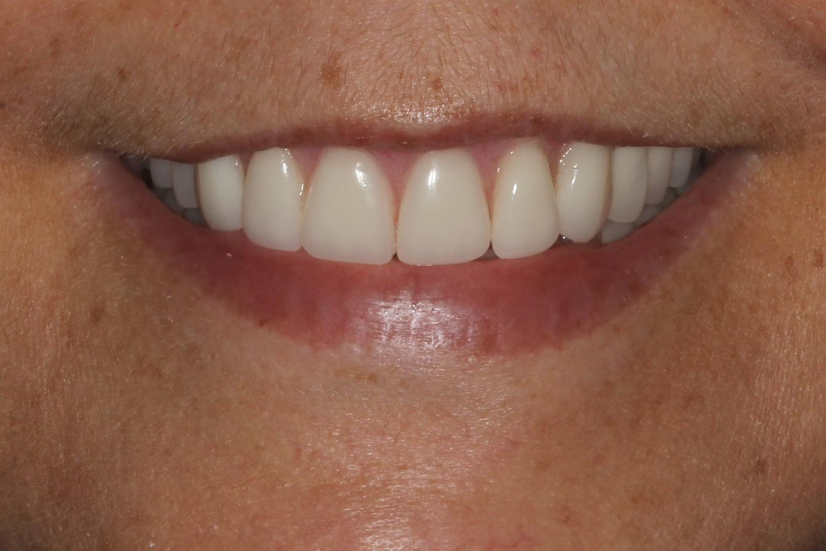 The Dentistry Collective smile makeover after — San Diego, CA
