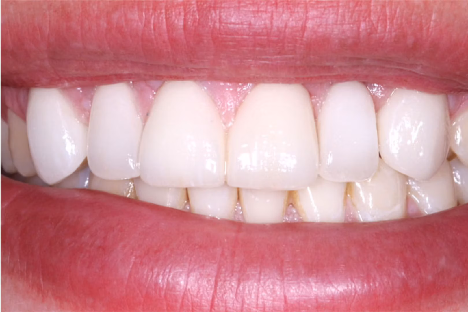 The Dentistry Collective veneers after — San Diego, CA