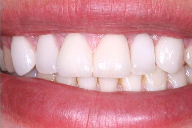 Dental Veneers after at The Dentistry Collective in San Diego, CA