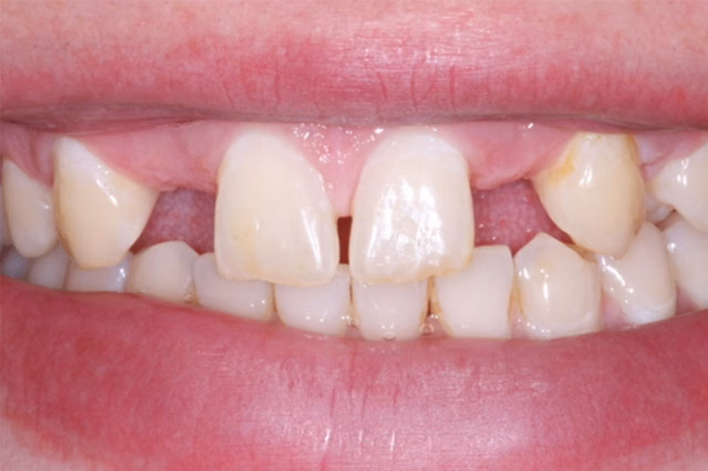 Dental Veneers before at The Dentistry Collective in San Diego, CA