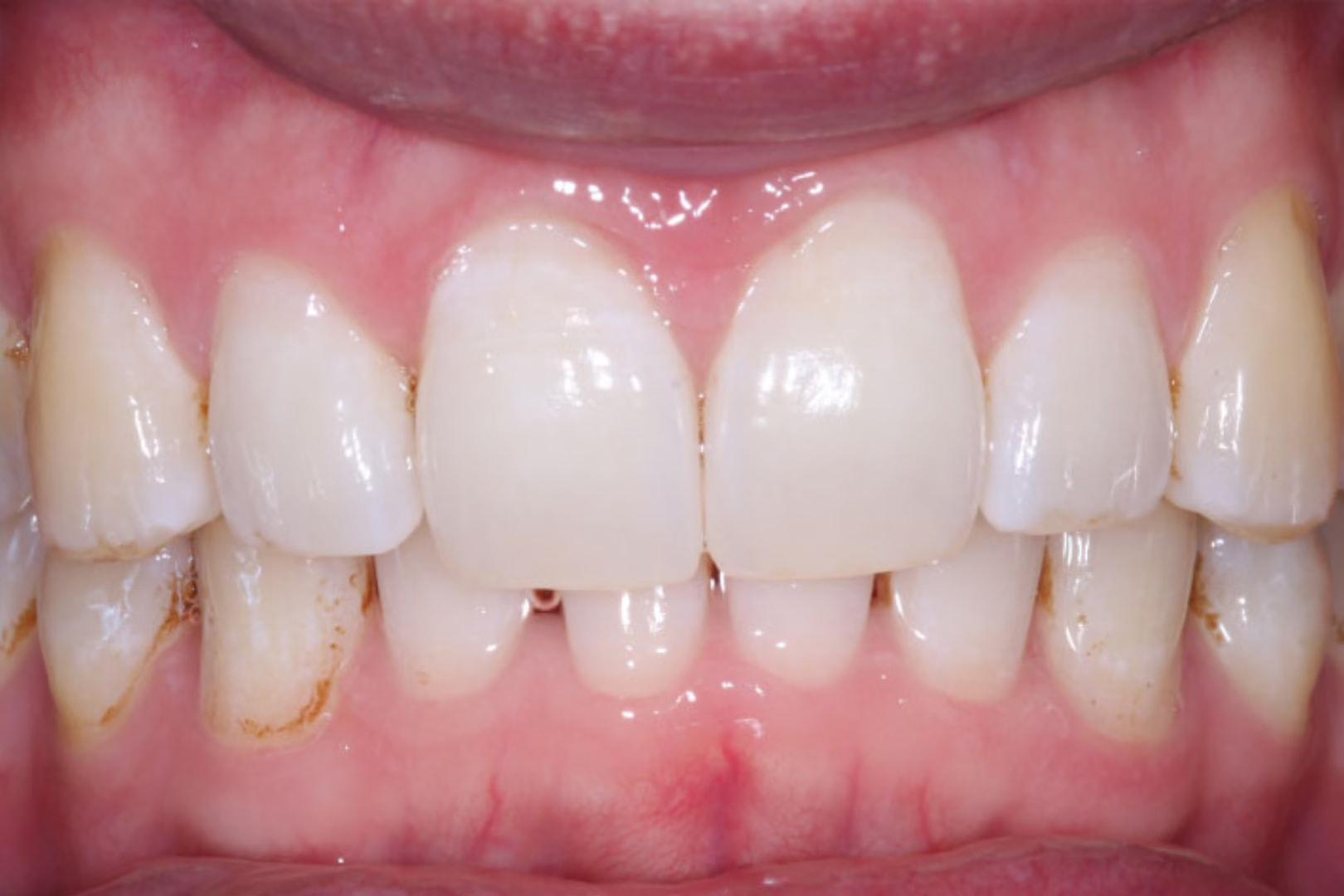 The Dentistry Collective smile makeover after — San Diego, CA