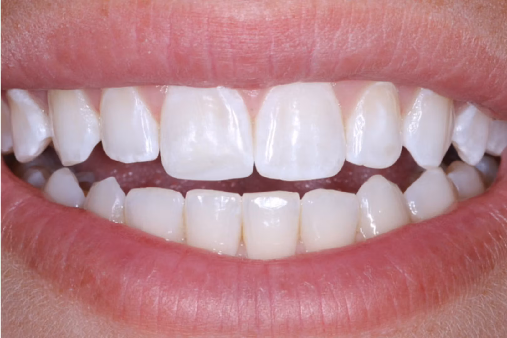 The Dentistry Collective dental bonding after — San Diego, CA