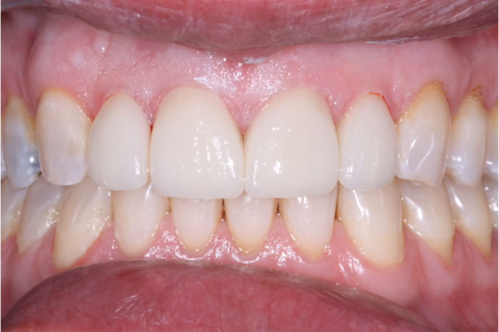 The Dentistry Collective dental crowns after — San Diego, CA