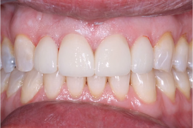 Dental Crowns after at The Dentistry Collective in San Diego, CA