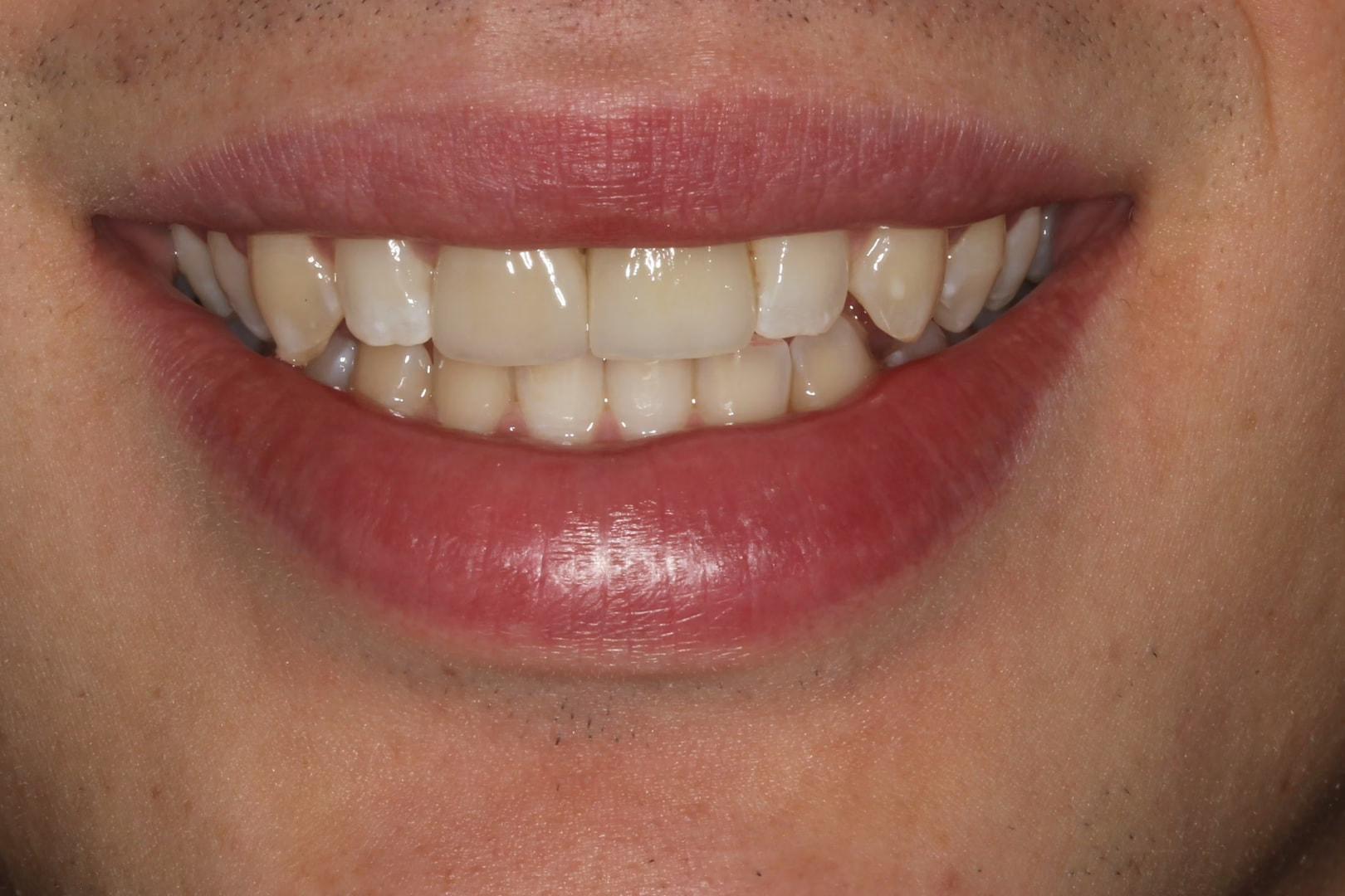 The Dentistry Collective dental crowns after — San Diego, CA