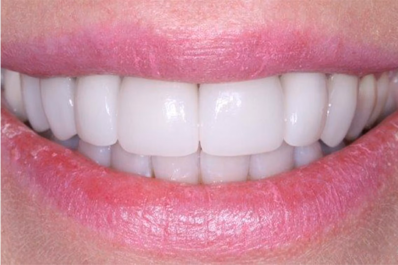 The Dentistry Collective dental crowns after — San Diego, CA