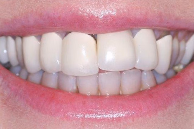 Dental Crowns before at The Dentistry Collective in San Diego, CA