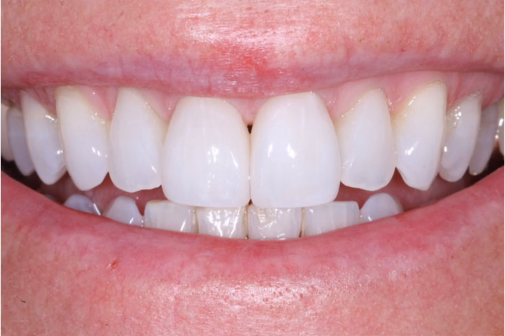 The Dentistry Collective veneers after — San Diego, CA